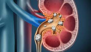 Can energy drinks Cause Kidney Stones
